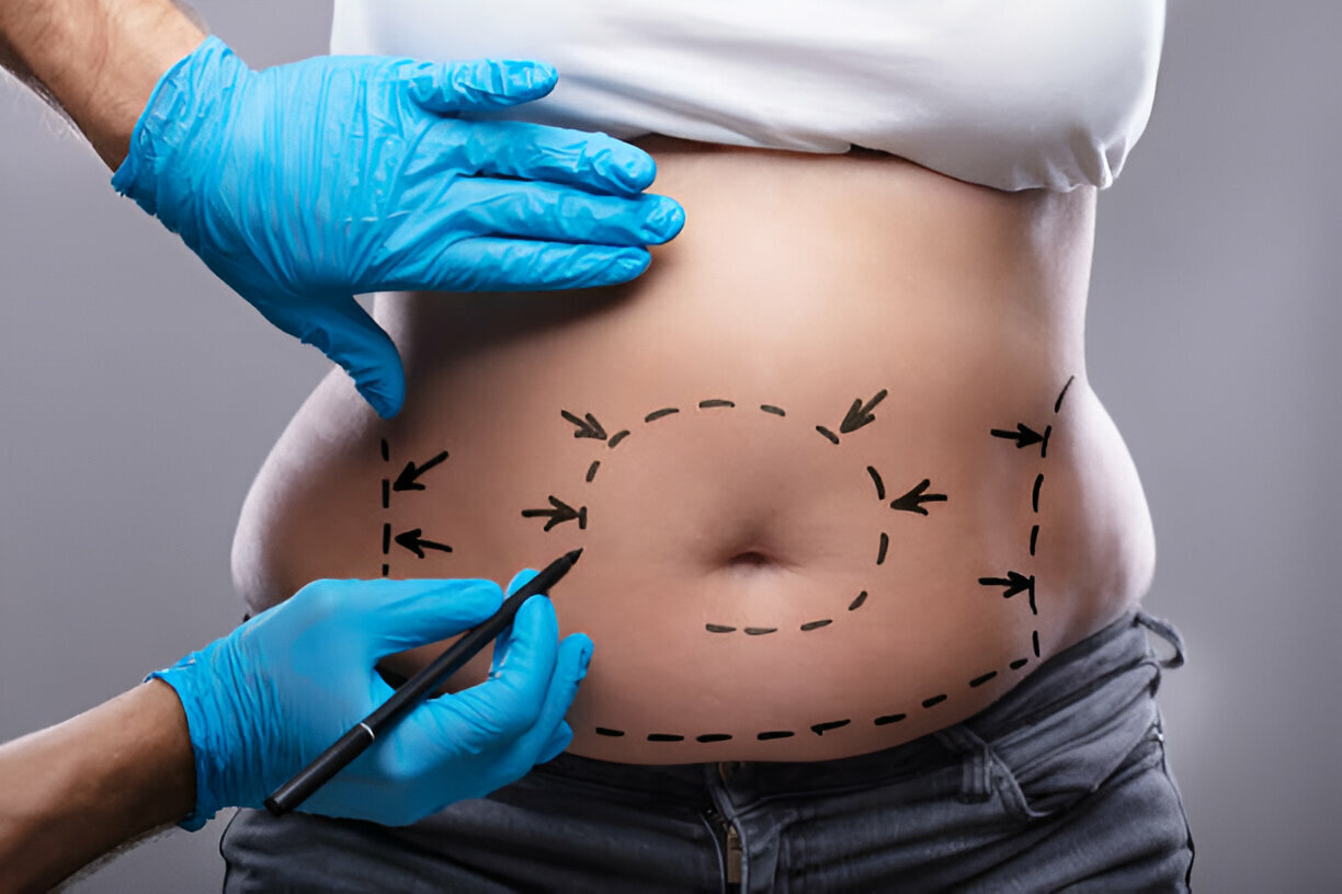 endolifting corporal